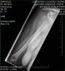 Dislocated Shoulder